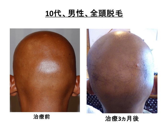円形脱毛症　病院